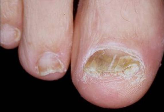 Bệnh nấm móng